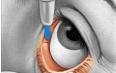 OJO SECO: COMPLICACIONES EN BLEFAROPLASTIA