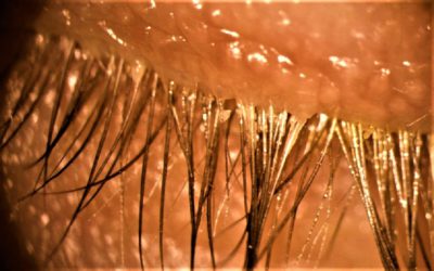 OJO SECO: BLEFARITIS POR DEMODEX